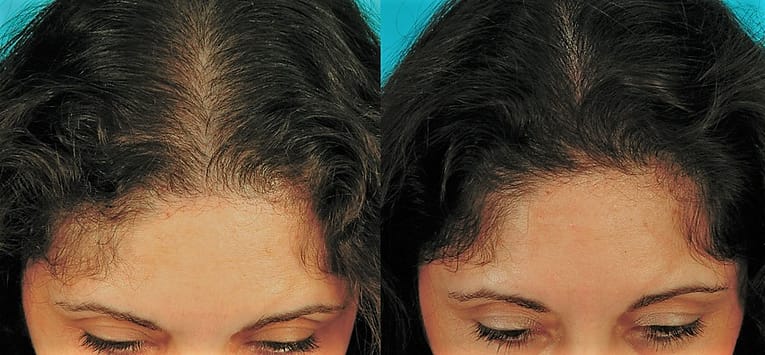 cure to stop hormonal hair loss